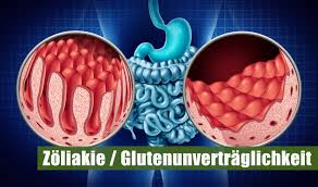 Zöliakie ist eine darmerkrankung, die zu schmerzen und blähungen führt. Zoliakie Und Glutenunvertraglichkeit Kochenohne