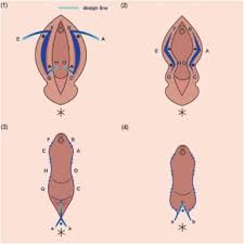 Image result for Labial Fusion
