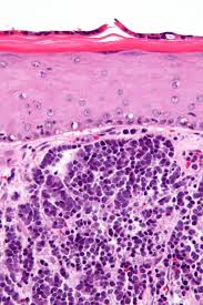 Merkel cells, found in the top layer of the skin, are very close to the nerve endings that receive the sensation of touch. Merkel Cell Carcinoma Wikipedia