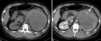 Im mrt wurde mir natürlich das kontrastmittel gespritzt und am eeg war ich nur auf der intensivstation! Bildgebende Verfahren Rontgen Ultraschall Ct Nuklearmedizin Abstract Europe Pmc