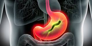 Be sure to take the full antibiotic. Magenentzundung Symptome Ursachen Und Behandlung Heilpraxis
