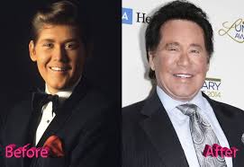 Experts maintain that he also had a subtle nose job, but the the crooner remains . Wayne Newton Plastic Surgery A Scary Midnight Idol