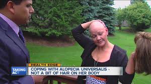 Alopecia totalis and alopecia universalis result in total loss of the hair on the scalp, and can affect other body hair as well, depending on which condition you have. Woman Living With Alopecia Universalis Youtube