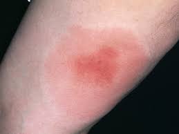 Dermatologist can help identify the type & the. Childhood Rashes Skin Conditions And Infections Photos Babycenter Australia