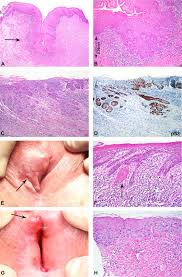 Image result for Vulvar Cancer