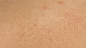 Molluscum most often happens in healthy kids between 1 and 12 years old. Molluscum Contagiosum Causes Symptoms Treatment And Pictures