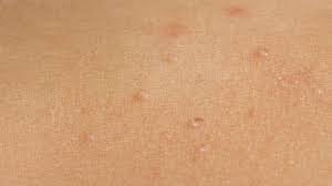 Molluscum most often happens in healthy kids between 1 and 12 years old. Molluscum Contagiosum Causes Symptoms Treatment And Pictures