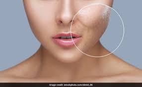 Popular products for gradually lessening the appearance of age spots often include lightening ingredient hydroquinone, such as murad rapid age spot pigmentation and lightening serum ($72) and neutrogena rapid tone dark spot corrector serum with retinol ($17). How To Remove Scars Of Pimples From Face Acne Scar Removal Tips At Home