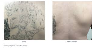 Custom tattoo in durango, co for over 25 years, your flesh tattoo has been durango, colorado's premier tattoo shop. The Lumenis Piqo4 Tattoo Durango Co Dermatologist