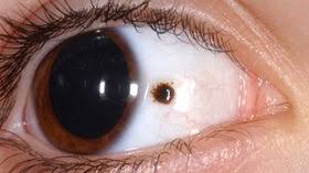 Image result for nevus sclerae