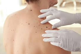 The signs and symptoms of skin cancer an include new skin lesions, a change in the shape, color, texture, or elevation of an existing mole, and much more. Top 5 Skin Cancer Symptoms U S Dermatology Partners Blog