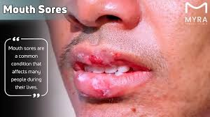 Image result for Physical injury red spots roof of mouth