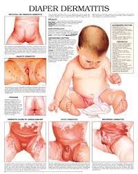Image result for diaper dermatitis