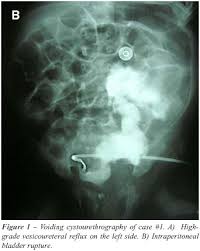 Image result for Voiding Cystourethrogram