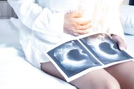 Lawati laman kami di www.doctoroncall.com.my untuk mengetahui penyebab, simptom dan cara mengatasinya. Kista Ovarium Jenis Gejala Komplikasi Halaman All Kompas Com