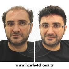 Dogal Gorunumlu Kivircik Protez Saclar 2020 Sac Dogal Sac Sac Dokulmesi