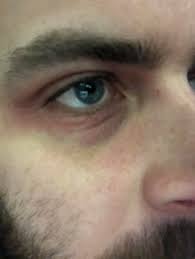 Skin Is Red Dry And Irritated Around My Eyes Any Advise On Treatments Uk Eczema