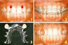 Falta Um Dente Posso Usar Aparelho Medo De Dentista