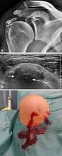 Image result for Rotator Cuff Calcification