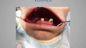 Zahnersatz Kosten Zahnersatz Implantate Kosten Bestezahnimplantate