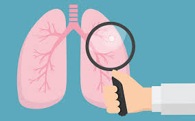 Not all people who get lung cancer are smokers. Should I Get A Lung Cancer Screening Cedars Sinai