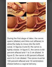 Effacement And Dilation Effacement Is Measured In Percentages 0 100 The Cervix Thins And Stretches Dila Natural Child Birth Prepare For Labor Cervix