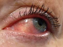 Image result for Scleritis