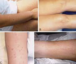 Birds can become sick from wnv, but do not spread the virus directly to people. Punctate Exanthem Of West Nile Virus Infection Report Of 3 Cases Sciencedirect