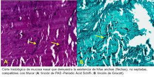 La mayoría de las personas entra en contacto con estos hongos en algún. Mucormicosis Rinocerebral Fulminante A Proposito De Un Caso Neurorecordings