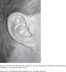 Image result for Relapsing Polychondritis