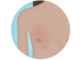 It could be a sign that your family carries an inherited breast cancer genetic mutation, such as brca1 or brca2 (see inherited risk/genetic disposition below). Breast Cancer Symptoms And Signs National Breast Cancer Foundation