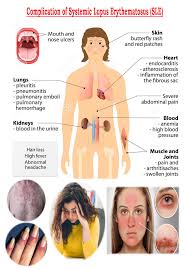 The signs and symptoms of lupus that you experience will depend on which body systems are affected by the disease. Systemic Lupus Erythematosus Sle Medicoinfo Lupus Body Tissues Chronic Inflammation
