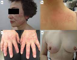 It's a very serious disease. Inflammatory Breast Cancer Associated With Amyopathic Dermatomyositis A Case Report Surgical Case Reports Full Text