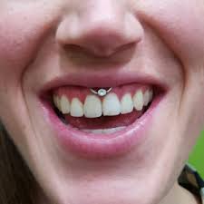 Before committing to doing a smiley piercing, your piercer will take a look at your frenulum first. About Oral Piercings