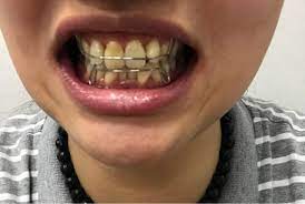 問題] 牙弓擴張器- 看板teeth_salon - PTT網頁版