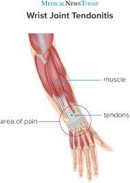 The extensor tendon compartments of the wrist are six tunnels which transmit the long extensor tendons of the forearm.they are located on the posterior aspect of the wrist. Wrist Tendonitis Treatment Symptoms Causes And More