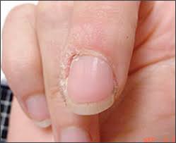 These are basically indicators of infection with human papillomavirus. Cutaneous Warts An Evidence Based Approach To Therapy American Family Physician