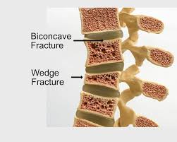 Image result for Vertebral Compression Fracture