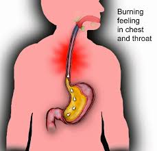 An acid is a molecule or ion capable of donating a proton , or, alternatively, capable of forming a covalent bond with an electron pair.1. Acid Reflux Diagnosis And Treatment San Diego Ent Specialists