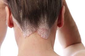 Surprisingly, ringworm has nothing to do with worms, but is a fungal infection that can occur anywhere on the body. Seborrhoeic Dermatitis Can It Cause Hair Loss
