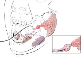Image result for Sialolithiasis