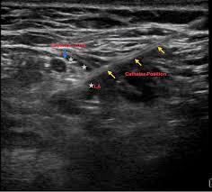 Image result for Superior Trunk Block