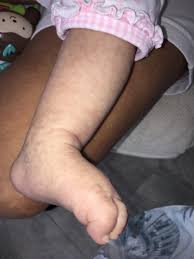 The red bumps are caused by the effect of the mother's. Skin Mottling On A Very Fair Newborn Newborn Mottled Skin