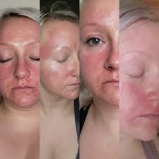 Gluten causing skin rashes despite gluten-free diet?