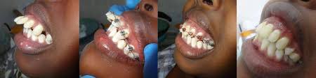 A simple clear aligner case (a minor teeth movement case that requires few months of treatment) costs about $2,800 usd or slightly. Braces Cost In Mexico Orthodontic Treatment Costs For Mexico 2019