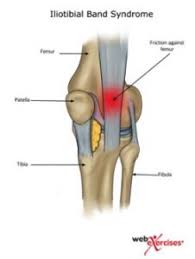 Ist wohl die häufigste ursache für schmerzen der knieaussenseite oder direkt unter der kniescheibe. 5 Exercises To Relieve It Band Syndrome Mobile Chiropractic And Wellness