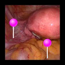 In laparoscopy, the anatomical perspective of the surgical field is somewhat different from the one as such, a laparoscopic left pelvic lymph node dissection may be technically somewhat more. Surgical Anatomy Of The Female Pelvis By Laparoscopy