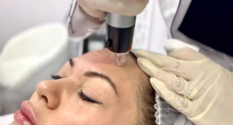 What Is Guide to Fractional RF Microneedling