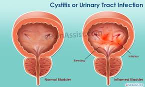 Cystitis Or Urinary Tract Infection Uti Symptoms Treatment Home Remedies