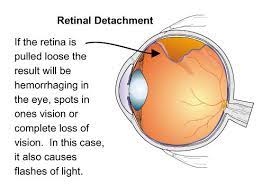 Retinal detachment repair is eye surgery to place a retina back into its normal position. Retinal Detachment The Signs Symptoms And Solutions Ocular Prosthetics Inc